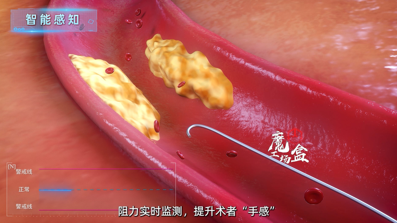血管手术机器人